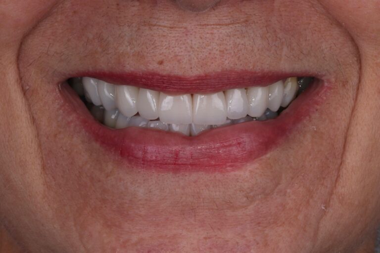 lentes de contato dental 2