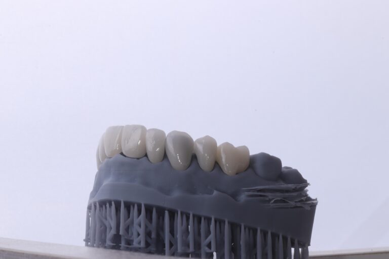 lentes de contato dental